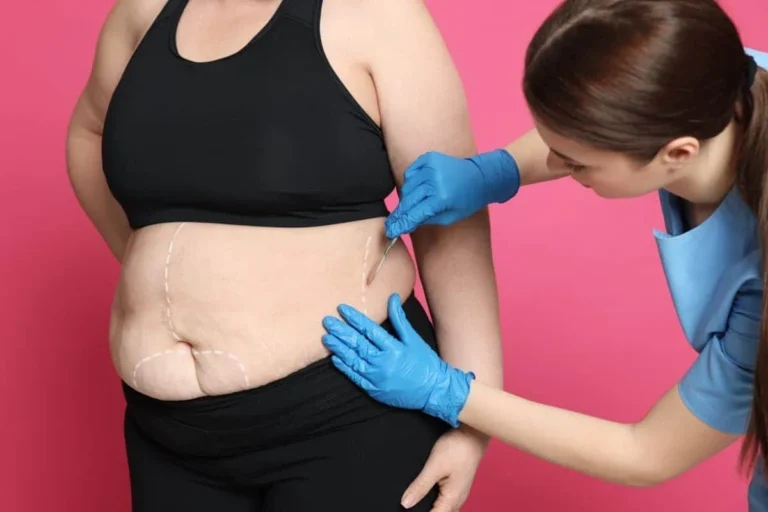 Weight Loss After Gallbladder Removal