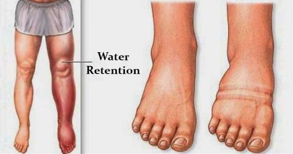 What Causes Water Retention?